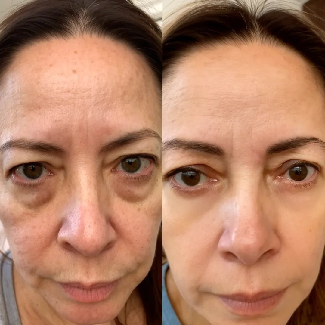 Curandar® 2-in-1 Red Light Therapy + EMS To Erase Eye Bags
